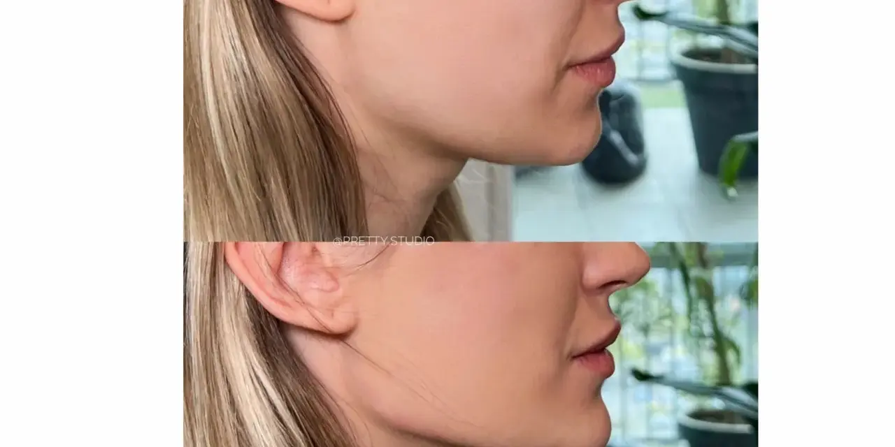 Endermologia twarzy: Lifting bez skalpela? Sprawdź efekty!