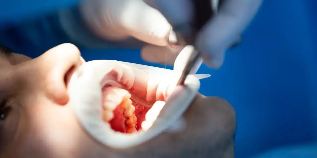 Dentysta wykonuje leczenie kanałowe zęba, używając narzędzi do precyzyjnej pracy w jamie ustnej pacjenta.