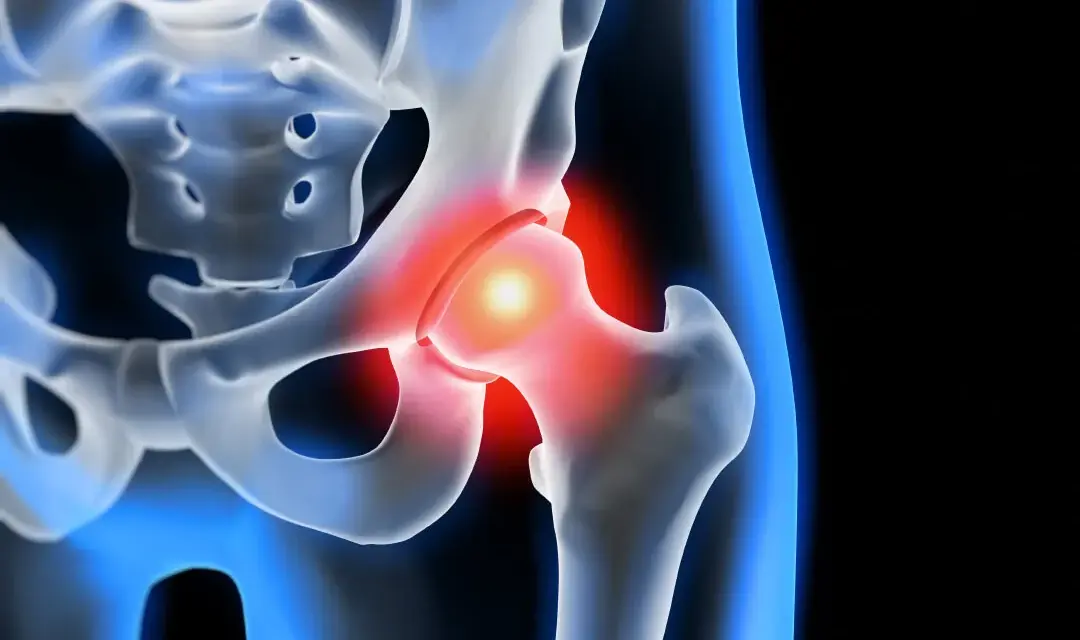 Coxarthrose Symptome: So erkennen Sie die schmerzhaften Anzeichen
