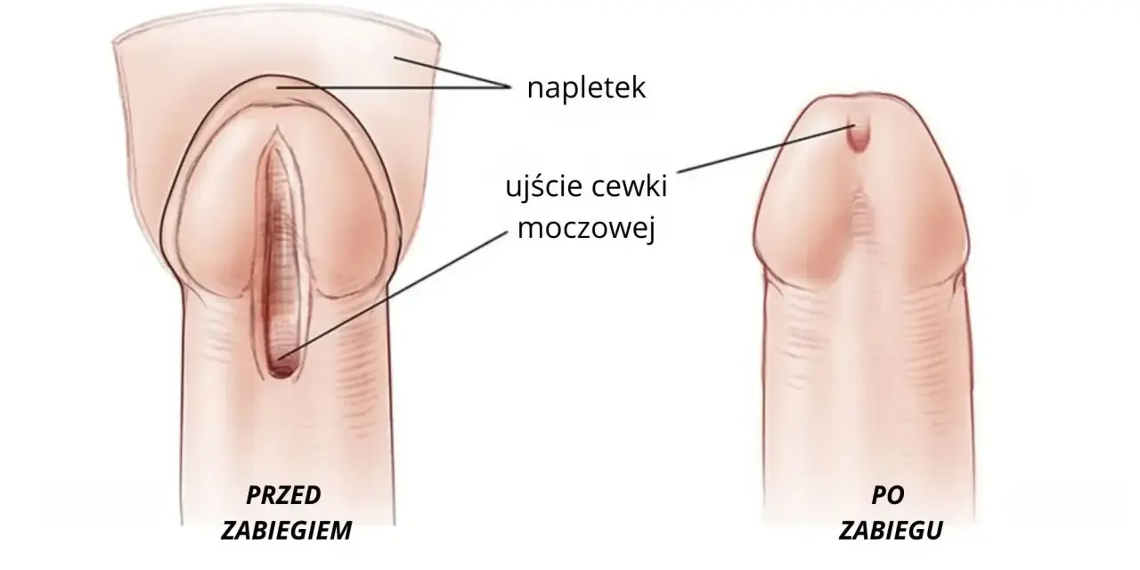 Ilustracja porównująca cewkę moczową przed i po zabiegu, z zaznaczonym napletkiem i ujściem cewki.