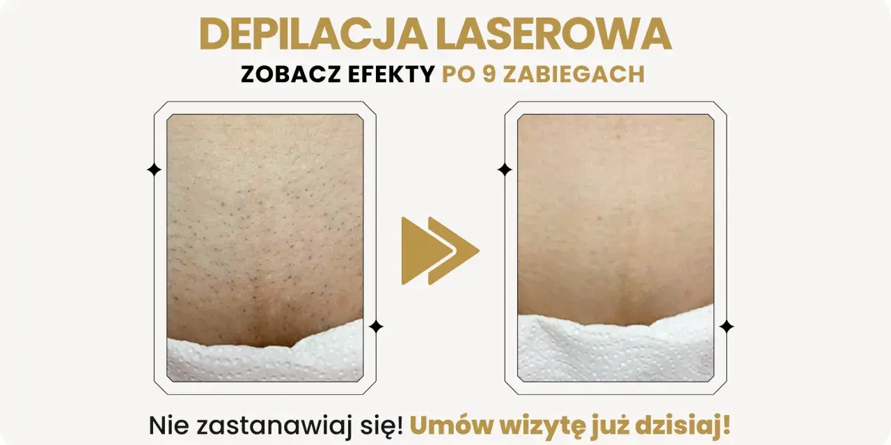 Depilacja laserowa bikini przed i po: widoczna redukcja owłosienia po 9 zabiegach. Gładka skóra bez podrażnień.