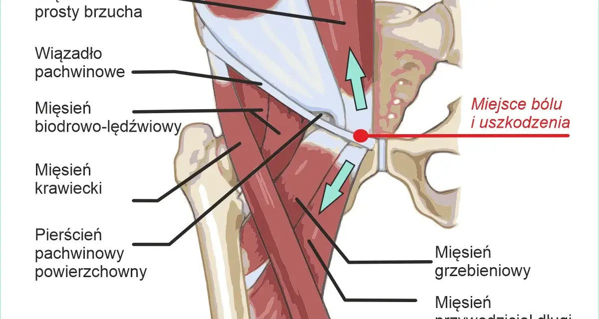 Anatomia pachwiny z zaznaczonym miejscem bólu i uszkodzenia. Ilustracja pokazuje mięśnie brzucha, biodrowo-lędźwiowy, krawiecki, grzebieniowy, przywodziciel długi oraz wiązadło pachwinowe.