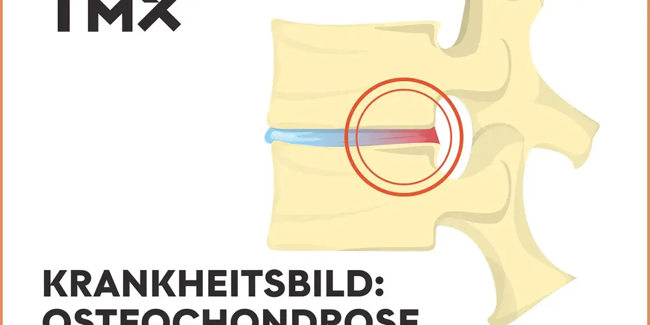 Darstellung eines Wirbels mit Bandscheibenschaden. Bei Osteochondrose wie geht es weiter? TMX Logo.