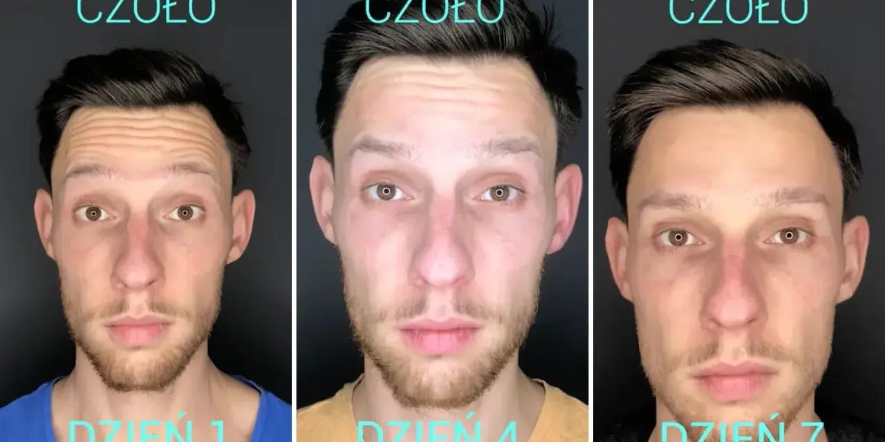 Przed i po baby botox na czole. Widoczne wygładzenie zmarszczek w ciągu 7 dni.