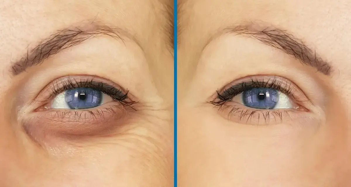 Antes y después de un tratamiento para reducir ojeras y arrugas. Ojos con ojeras oscuras y piel arrugada a la izquierda, y ojos con piel lisa y sin ojeras a la derecha.