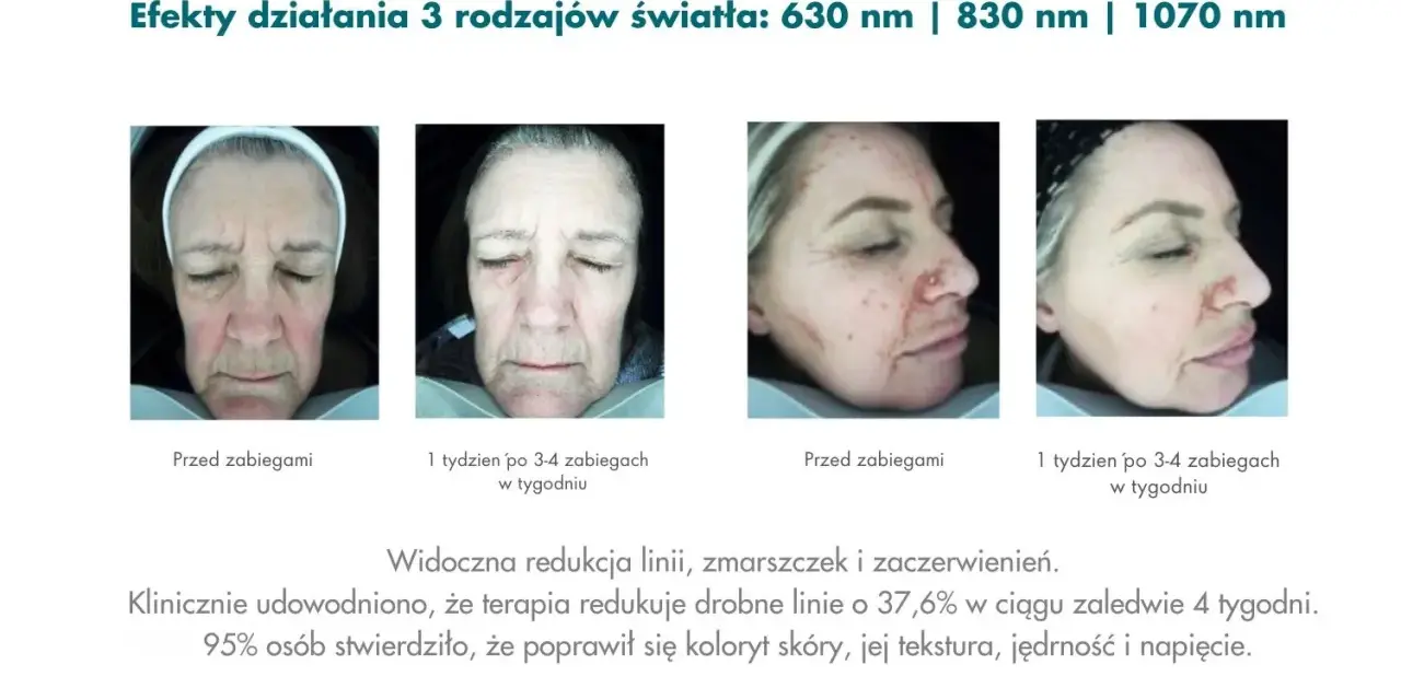 Przed i po terapii światłem LED w domu. Zmniejszenie zmarszczek i zaczerwienień. Poprawa kolorytu, tekstury i jędrności skóry.
