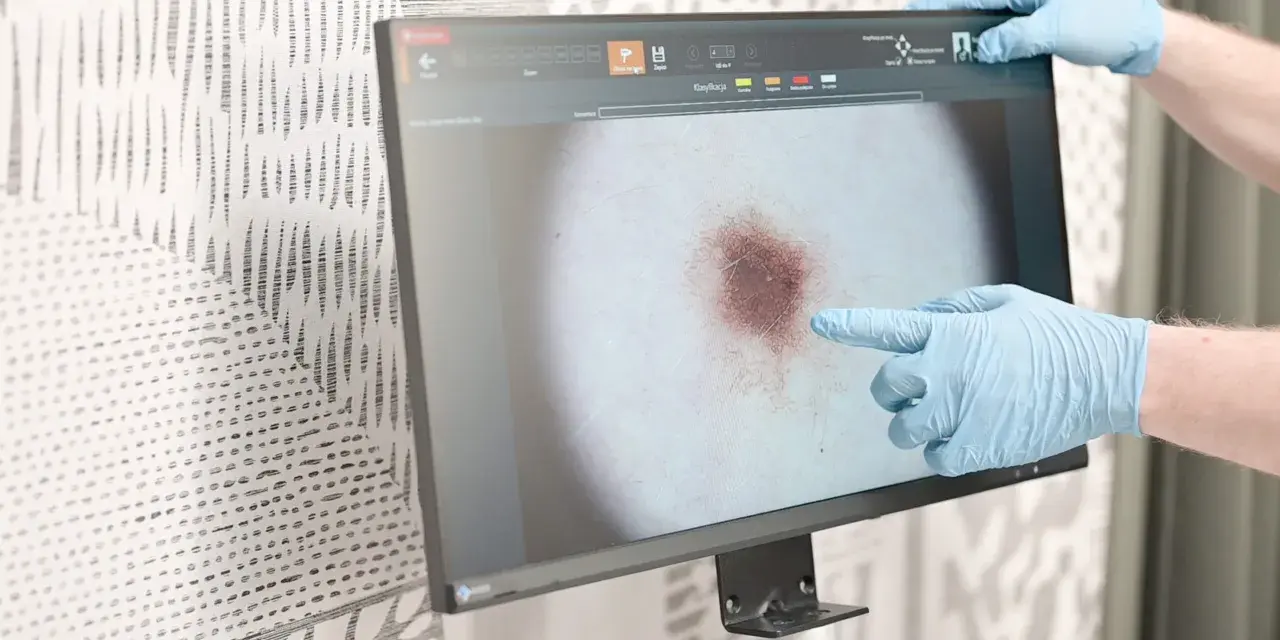 Dłoń w niebieskiej rękawiczce wskazuje na powiększone znamię na ekranie dermatoskopu.