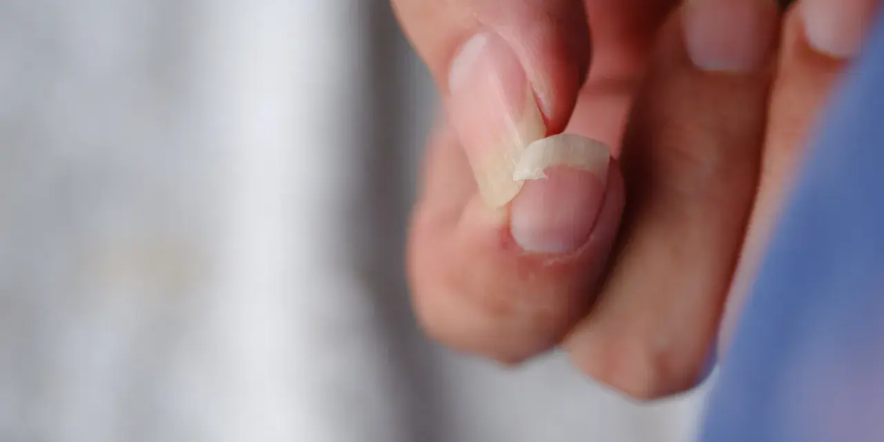 Un ongle se casse, une question se pose : pourquoi mes ongles se cassent ? Gros plan sur un ongle abîmé.