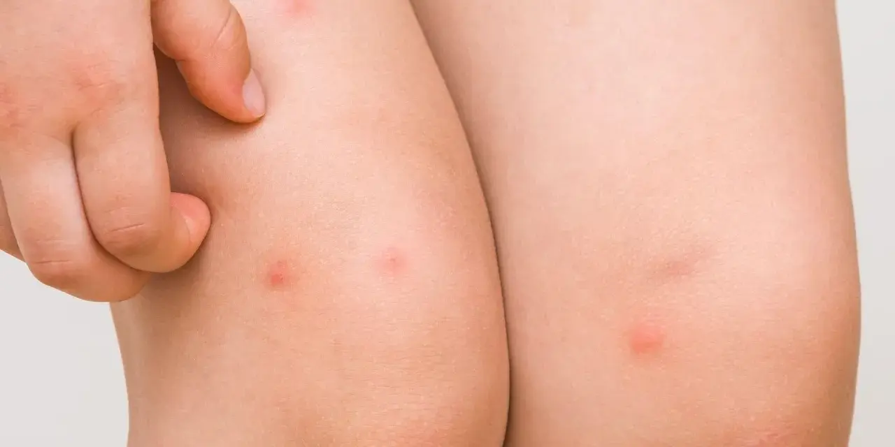 Piel de niño con pequeños bultos rojos, indicativos de foliculitis en las piernas.