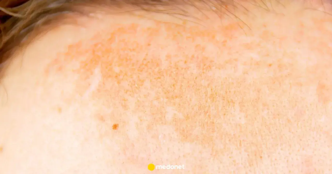 Skóra z zaczerwienieniem i przebarwieniami, objawy fotodermatozy – uczulenia na słońce. Widoczne włoski i pieprzyk.