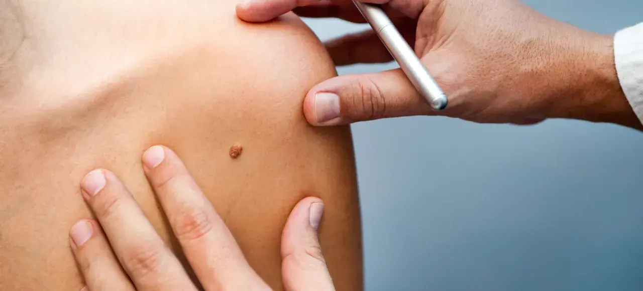Examen d'un grain de beauté sur l'épaule, un médecin utilise un stylo pour le marquer.