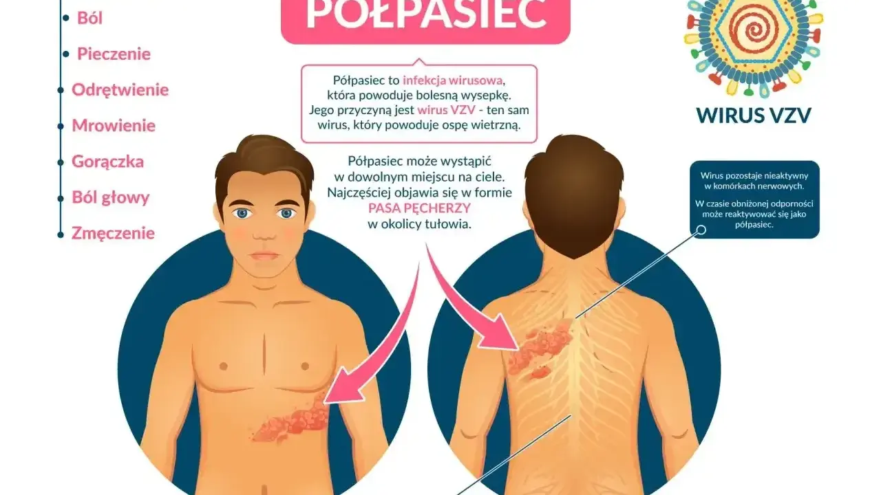 Objawy półpaśca: ból, pieczenie, odrętwienie, mrowienie, gorączka, ból głowy, zmęczenie. Jak złagodzić ból przy półpaścu? Półpasiec to wirus VZV.