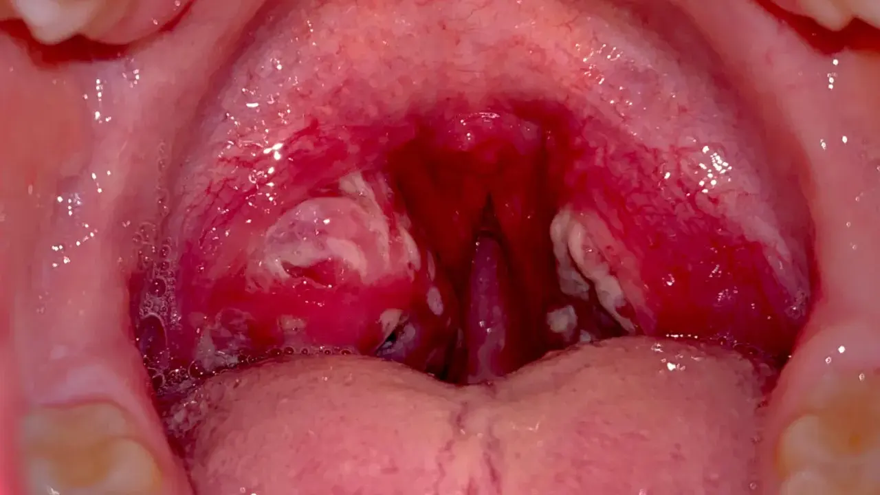 Gola infiammata con placche biancastre, indicative di faringite da streptococco. Le tonsille sono rosse e gonfie.
