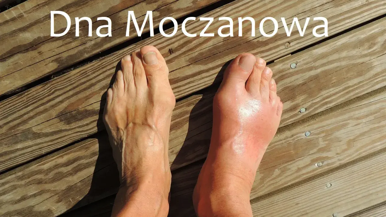Dwa stopy na drewnianym tle, jeden zdrowy, drugi opuchnięty i zaczerwieniony.