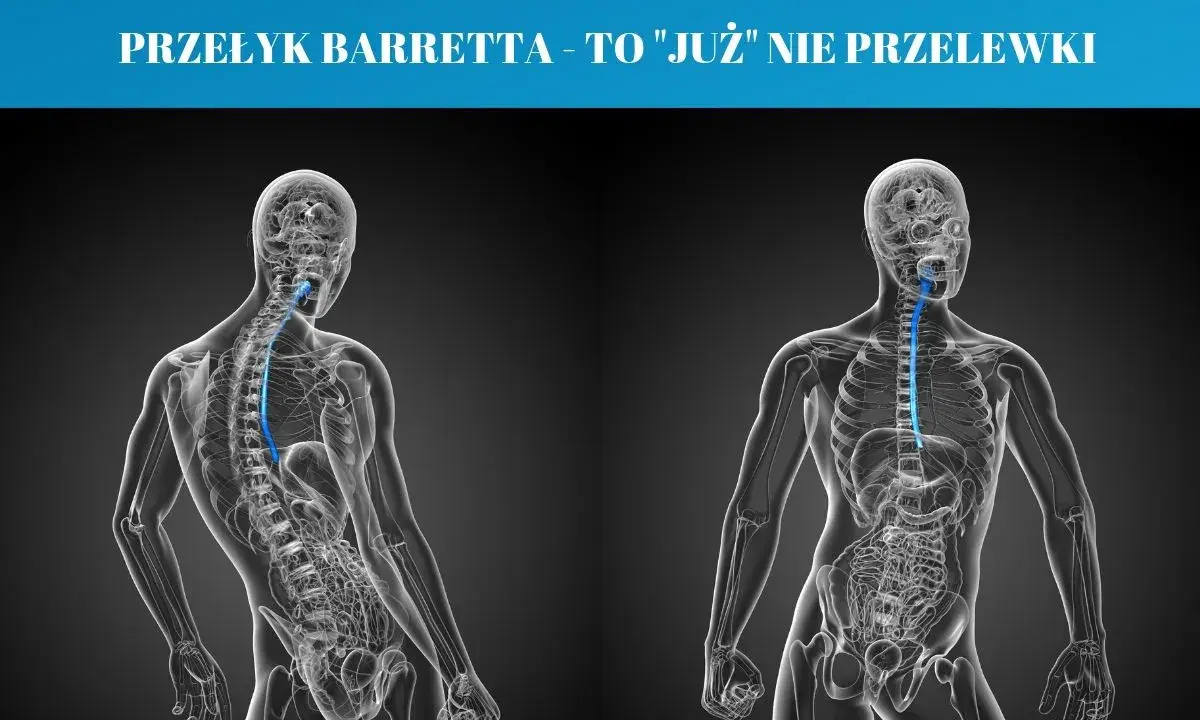 Przełyk Barretta objawy: schematyczne sylwetki ludzkie ukazujące przełyk. Po lewej widok z tyłu, po prawej z przodu.