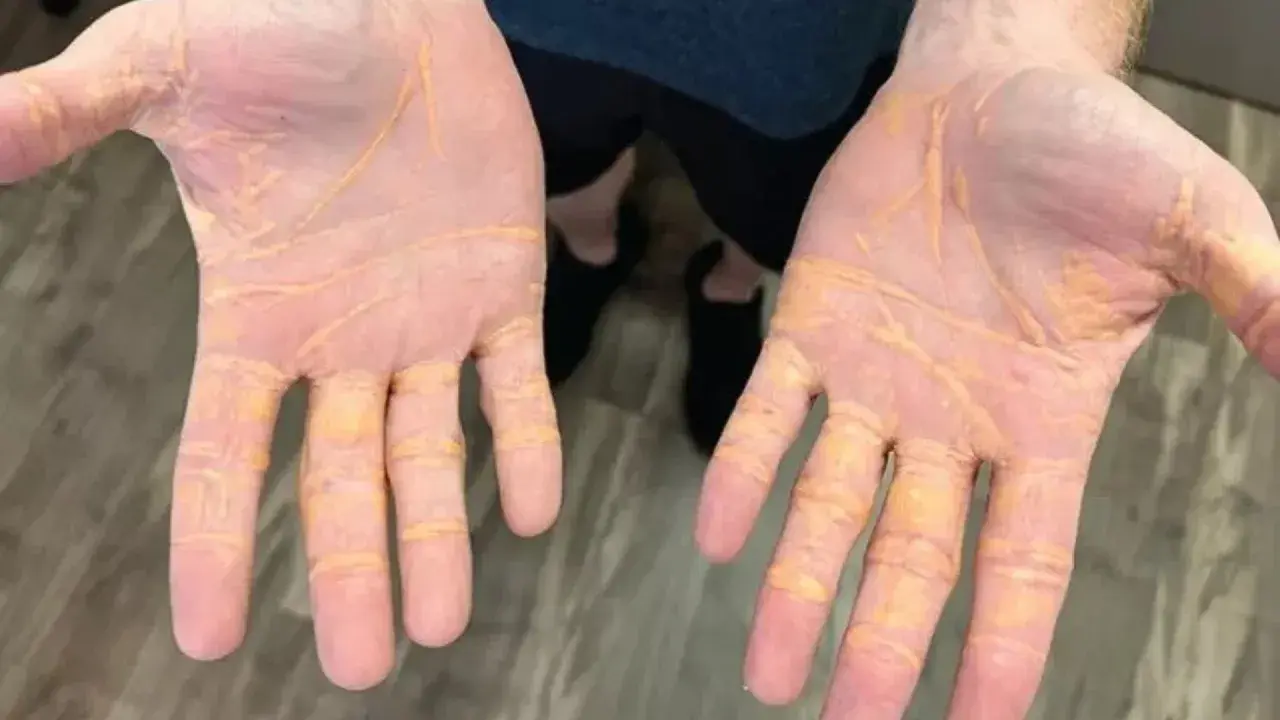 Dłonie z żółtymi zmianami skórnymi, mogącymi świadczyć o wysokim cholesterolu.