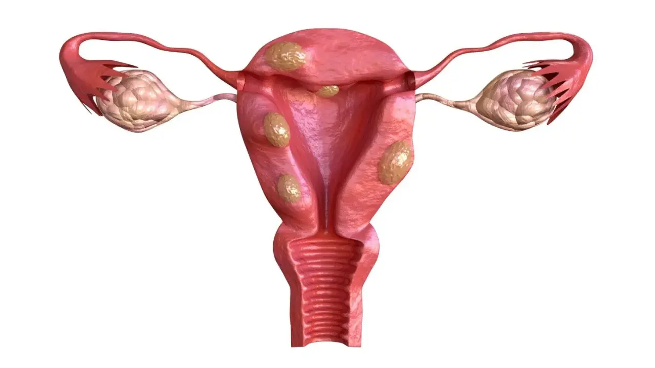 Anatomical illustration of a uterus with multiple fibroids and ovaries.