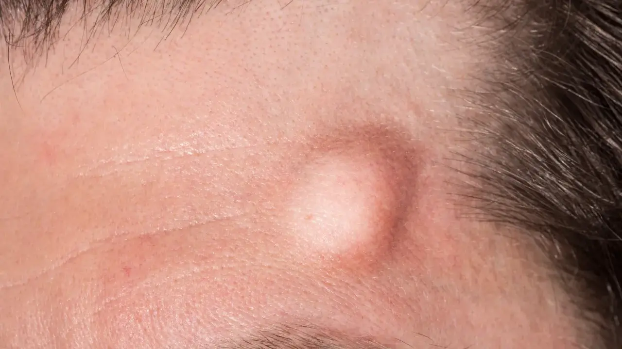 Gros plan sur un front humain, montrant un bouton sous cutané proéminent, légèrement rouge, près de la ligne des cheveux.