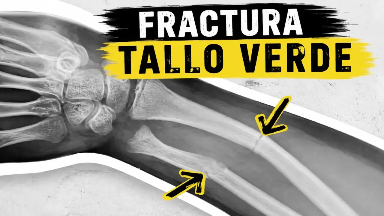 Radiografía de una fractura en tallo verde en el antebrazo, indicada por flechas amarillas.
