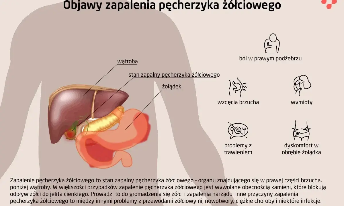 Ilustracja przedstawia anatomię jamy brzusznej z zaznaczonym pęcherzykiem żółciowym, wątrobą i żołądkiem. Wymienia objawy zapalenia pęcherzyka żółciowego: ból, wzdęcia, wymioty, problemy z trawieniem.
