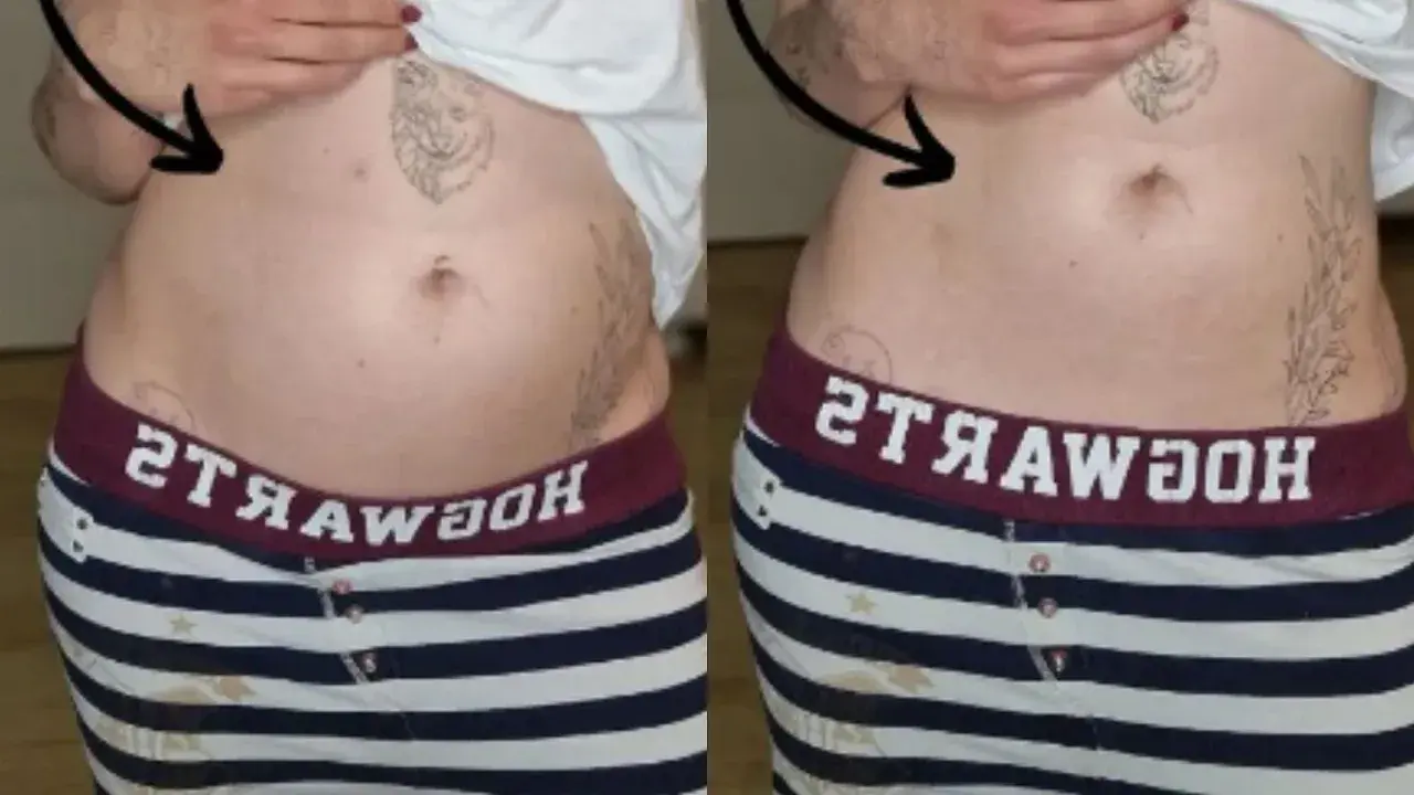 Porównanie brzucha: po lewej widoczne wzdęcia, po prawej płaski. Endometrioza jak wygląda? Czasem tak.