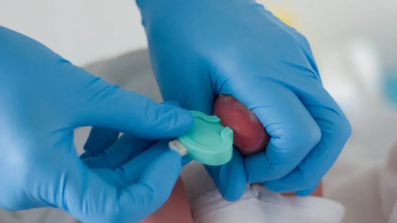Mani con guanti blu eseguono il test di Guthrie su un neonato, raccogliendo una goccia di sangue dal tallone.