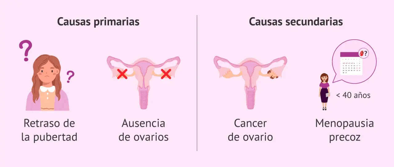 ¿Qué pasa si no te baja la regla en un mes? Causas primarias: retraso pubertad, ausencia ovarios. Causas secundarias: cáncer ovario, menopausia precoz.