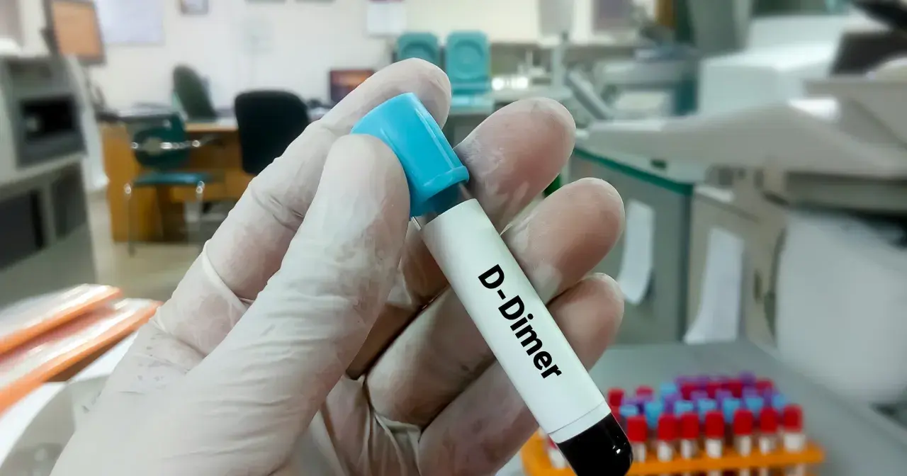 Rękawiczka trzyma probówkę z napisem "D-Dimer". W tle laboratorium, gdzie można dowiedzieć się, d-dimery jak obniżyć.