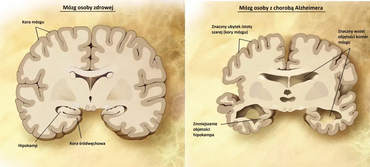 Porównanie mózgu zdrowego i z chorobą Alzheimera: widoczne zmniejszenie hipokampa i kory mózgowej, co jest kluczowe w demencji.