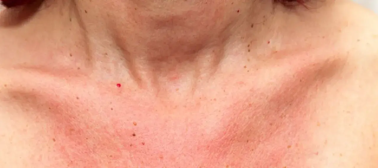 Peau rougie et irritée sur le cou et le décolleté, peut-être une réaction à une allergie au soleil. Combien de temps dure une allergie au soleil ?