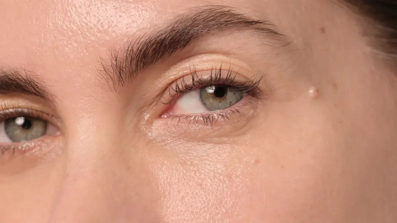 Gros plan sur un œil, montrant une peau claire avec une petite lésion sur la paupière, possiblement un signe de psoriasis paupière.
