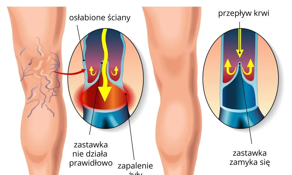 Porównanie żylaków i zdrowych żył. W żylakach zastawka nie działa, powodując zastój krwi. W zdrowych żyłach zastawka zamyka się prawidłowo.