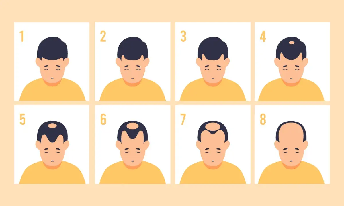 Illustration montrant les 8 stades de la calvitie héréditaire, de la chevelure complète à la calvitie totale.