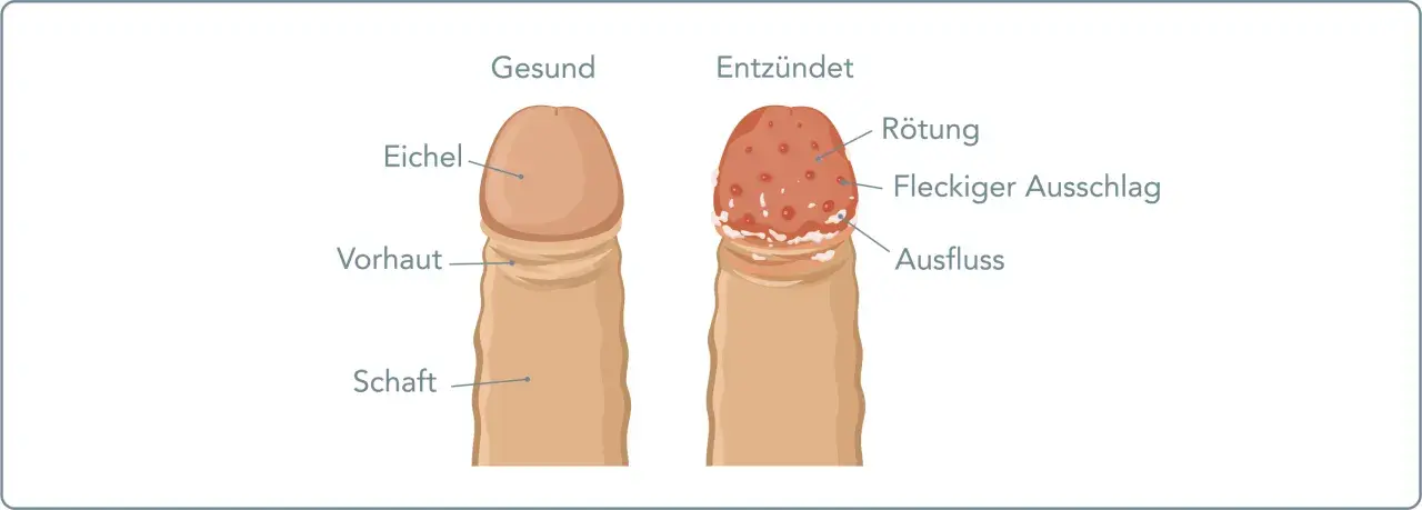 Vergleich von gesunder Eichel und entzündeter Eichel mit roten Punkten, Rötung, fleckigem Ausschlag und Ausfluss.