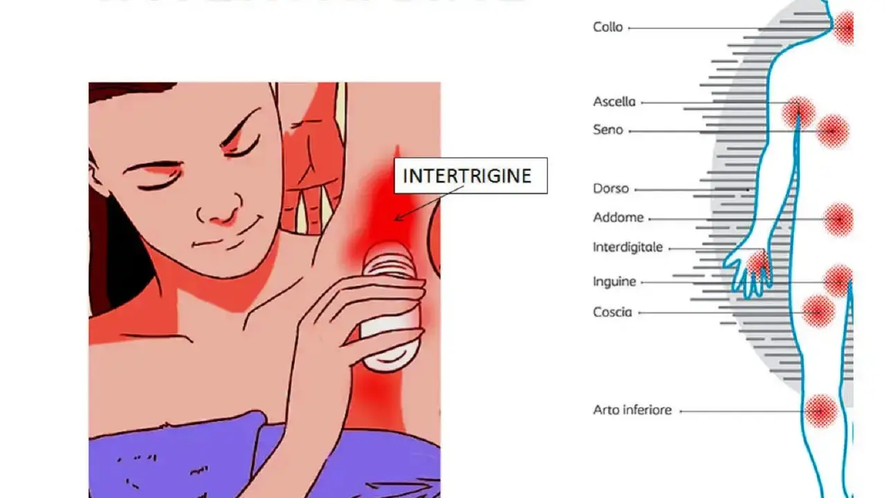 Intertrigine sotto il seno: rimedi della nonna per il rossore. Illustrazione mostra zone colpite da intertrigine.