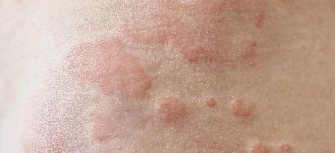 Czerwone, swędzące bąble na skórze. Czy pokrzywka jest zaraźliwa? Nie, to reakcja alergiczna, nie przenosi się przez kontakt.