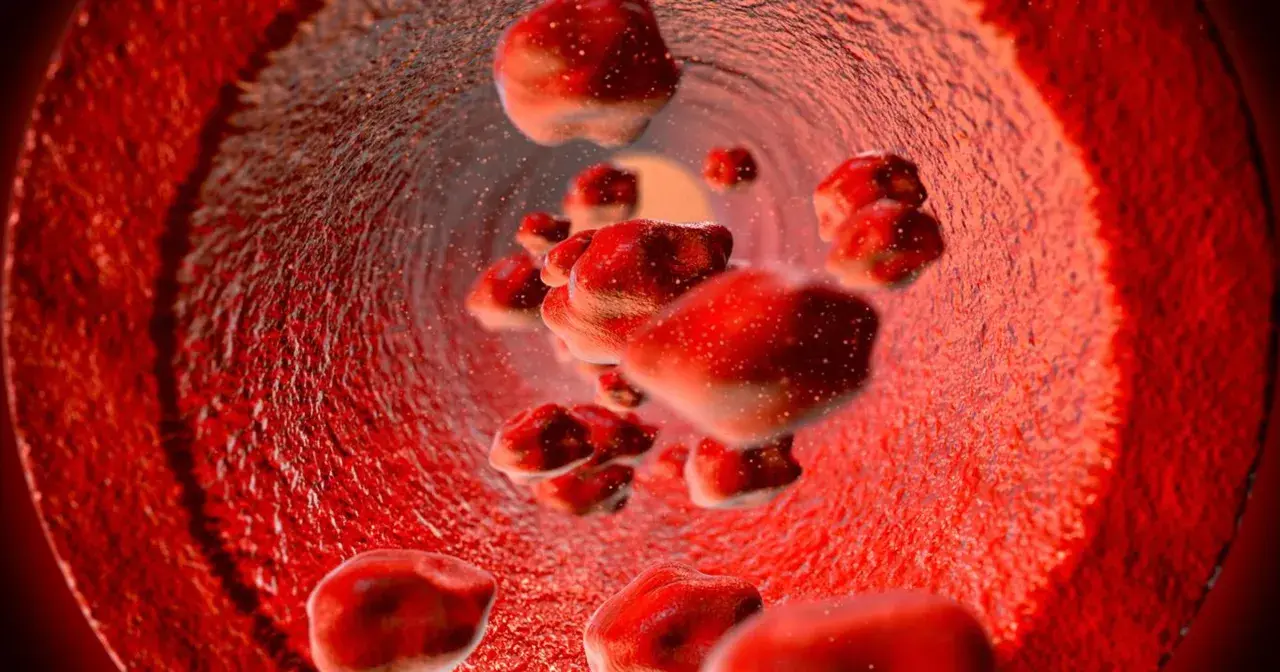 Czerwienica prawdziwa to choroba mieloproliferacyjna, nie nowotwór złośliwy. Widok naczyń krwionośnych z nadmiarem czerwonych krwinek.