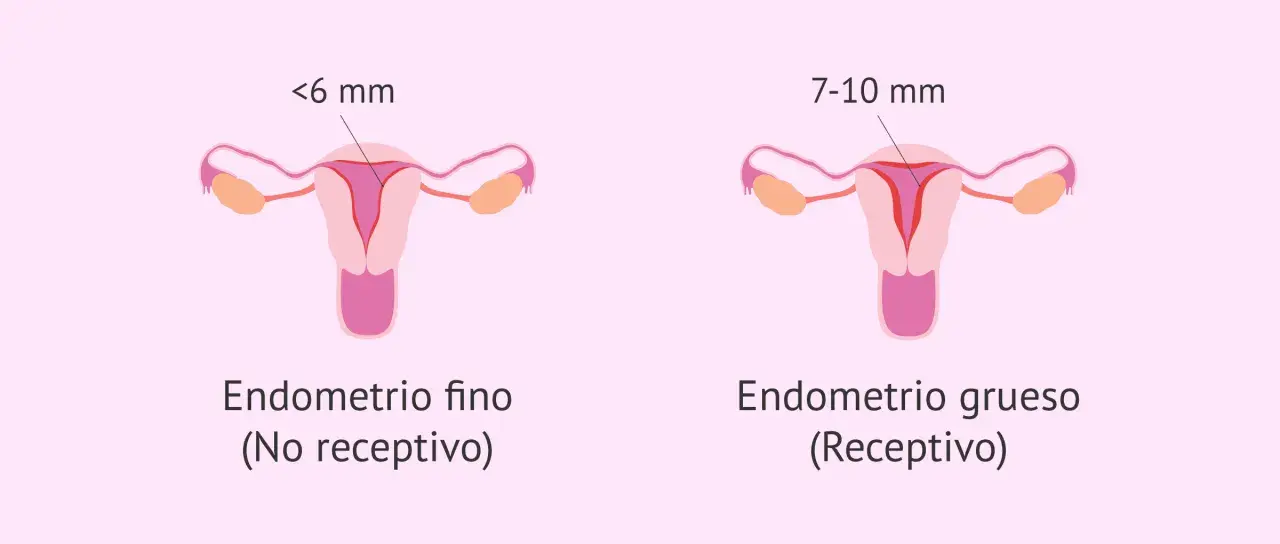 Ilustración comparativa de úteros. Uno muestra un endometrio fino (<6 mm, no receptivo), el otro un endometrio grueso (7-10 mm, receptivo).