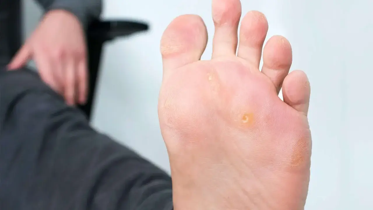 Un pied présente des cors, notamment un cors au pied bien visible sous la plante. La personne semble s'apprêter à soigner cette affection.