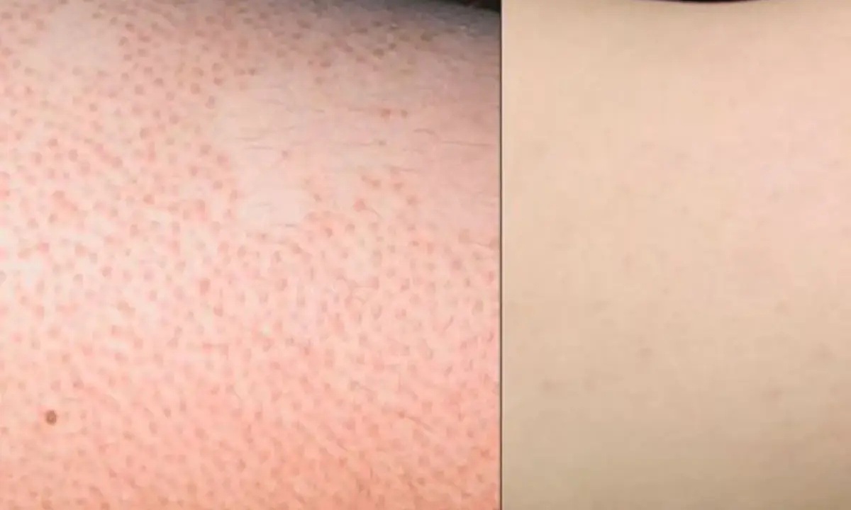 Piel con poros dilatados y vello, aspecto de "strawberry legs", comparada con piel lisa y clara.