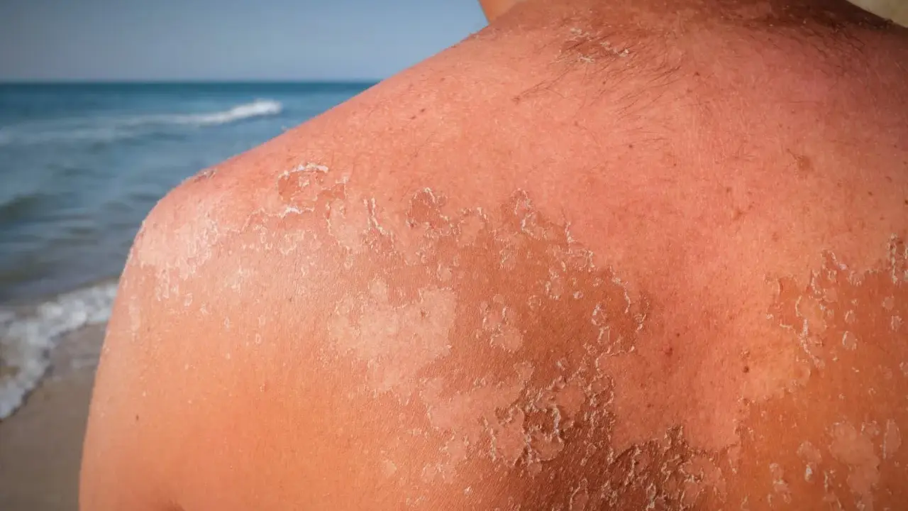 Peau qui pèle après un coup de soleil. La guérison peut prendre plusieurs jours, voire semaines.