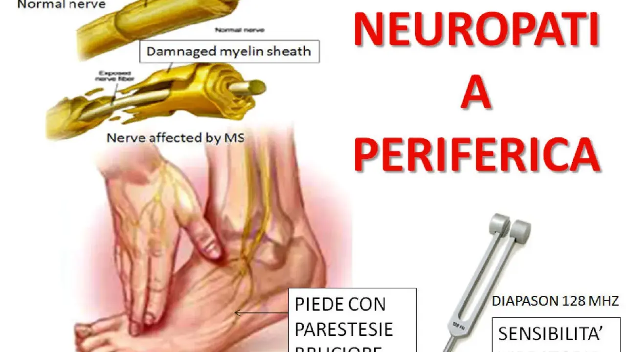 Illustrazione di neuropatia periferica con sintomi come parestesie e bruciore al piede, e diapason per testare la sensibilità vibratoria.