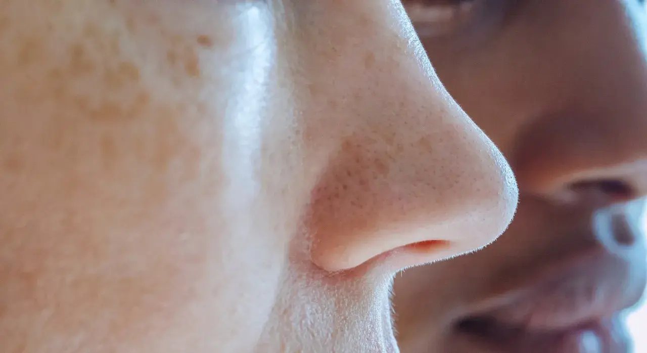 Gros plan sur un nez humain, montrant des pores dilatés et des filaments sébacés. Des taches de rousseur parsèment la peau.