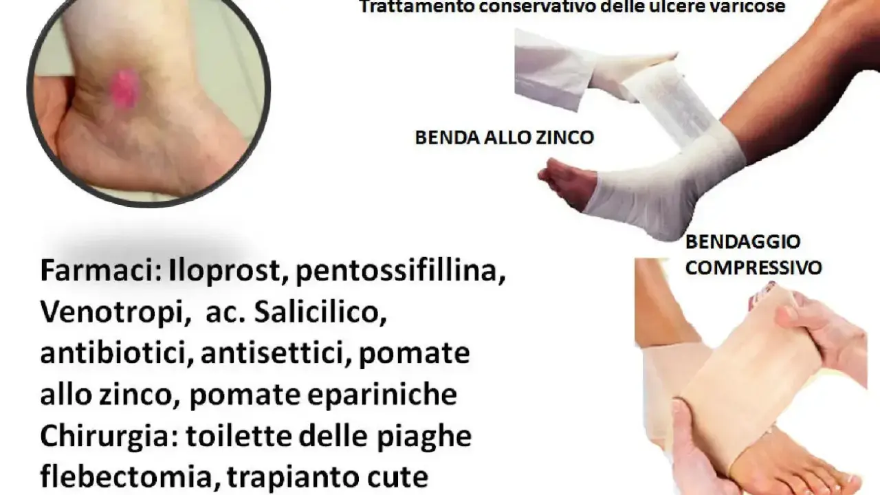 Trattamento conservativo per ulcere venose: bendaggio allo zinco e compressivo, farmaci e chirurgia.