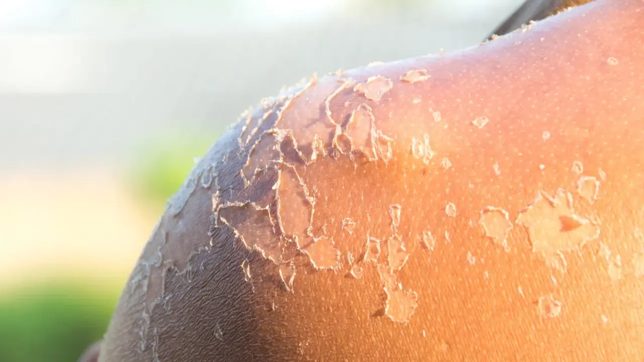Peau qui pèle après un coup de soleil. La guérison peut prendre plusieurs jours, voire une semaine.