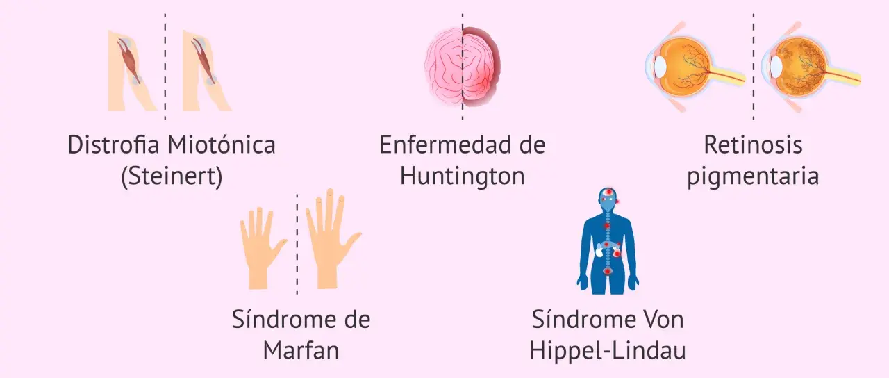 Ilustraciones de distrofia miotónica, Huntington, Marfan, Von Hippel-Lindau y retinosis pigmentaria, ejemplos de herencia autosomica dominante.