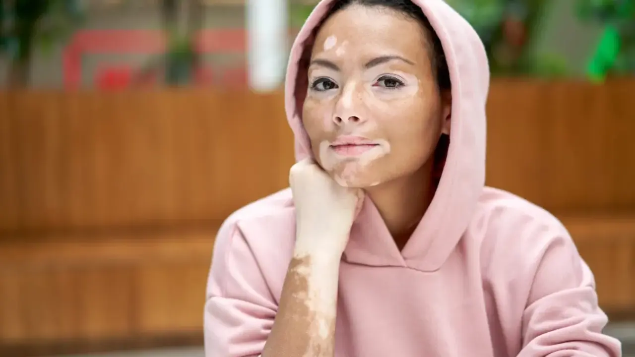 Jeune femme au visage et bras marqués par la dépigmentation de la peau, portant un sweat à capuche rose.