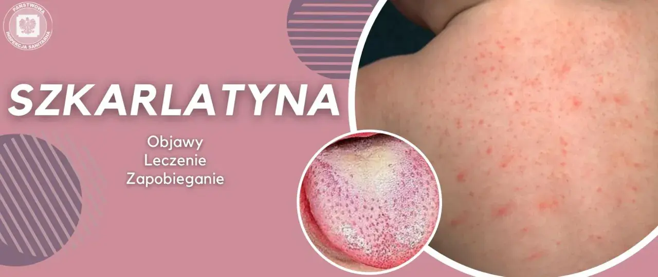 Szkarlatyna: czerwona wysypka na skórze i malinowy język. Objawy, leczenie i zapobieganie. Podobne do rumienia zakaźnego, ale wymaga innej diagnostyki.