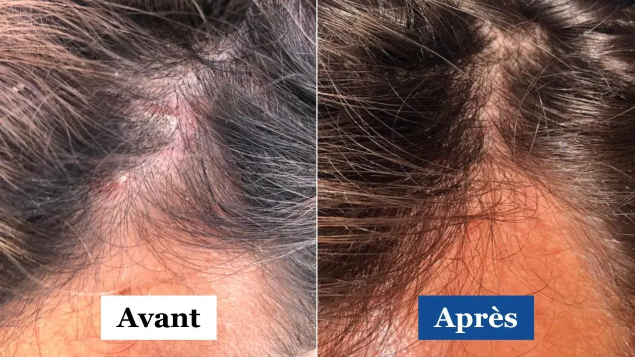 Comparaison avant/après d'un cuir chevelu atteint de psoriasis et dermite séborrhéique. La partie gauche montre des plaques rouges et squameuses, la droite une peau apaisée.