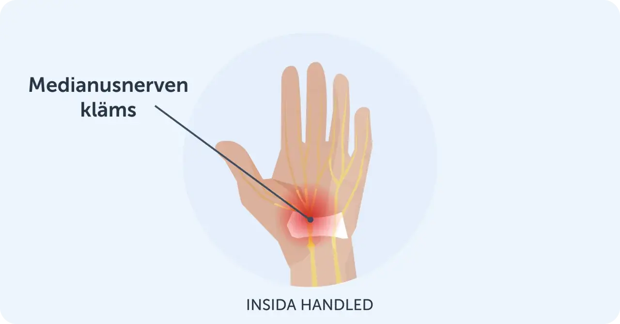 Illustration av handleden där medianusnerven kläms, vilket orsakar karpaltunnelsyndrom och ont i tummen.